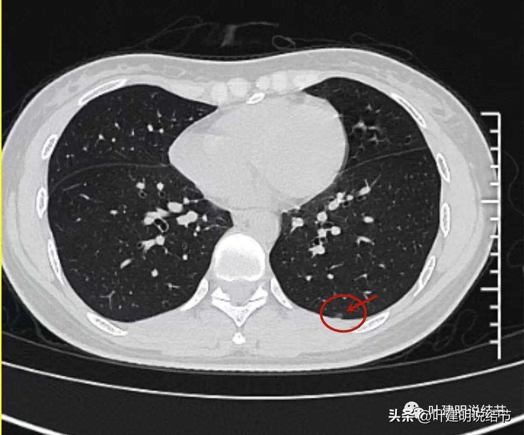 肺结节最早手术标准，理解、应用与进展的探讨及实践指南