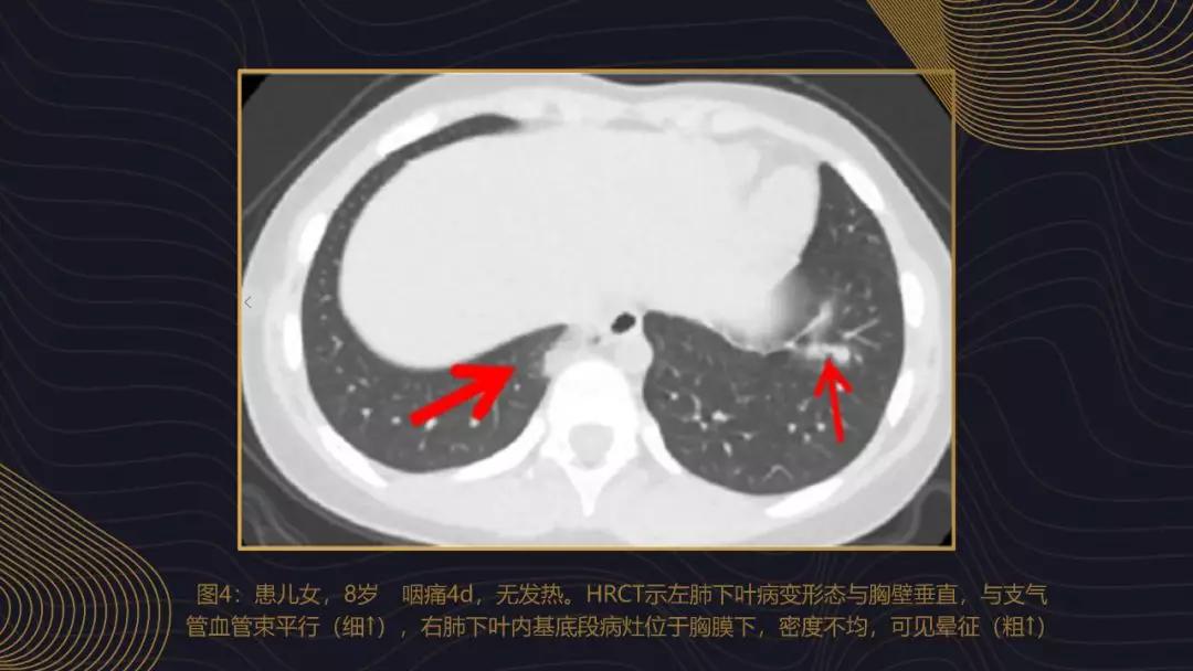 新加坡新冠肺炎最早增